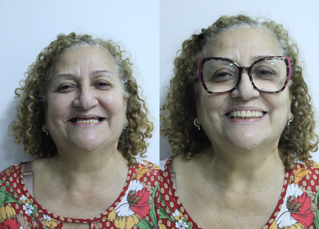 Antes e depois — Prótese dentária