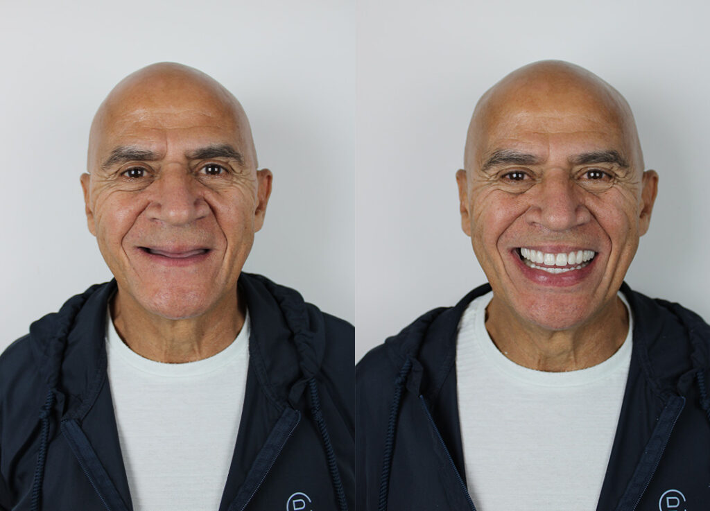 Antes e depois — Reabilitação completa