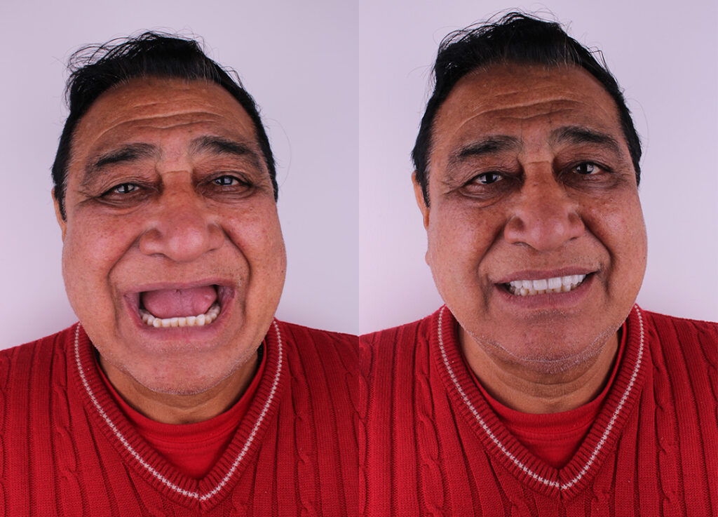 Antes e depois — Alinhamento e harmonização